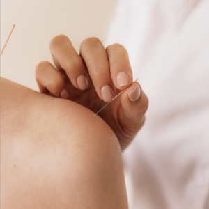 Acupuncturist administering acupuncture to a client using a fine needle, focusing on the therapeutic practice of traditional Chinese medicine